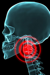 頸椎捻挫（けいついねんざ）イメージ